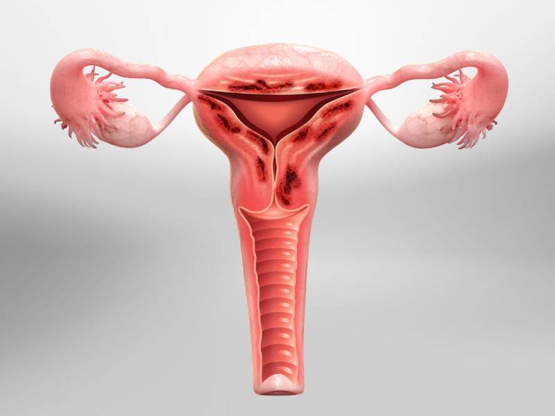 Adenomyosis treatment