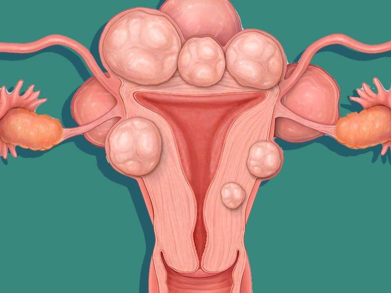 Fibroid Uterus