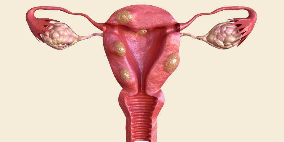 Fibroids and Fertility