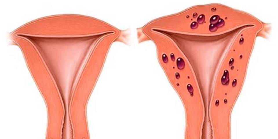 Know All About Adenomyosis