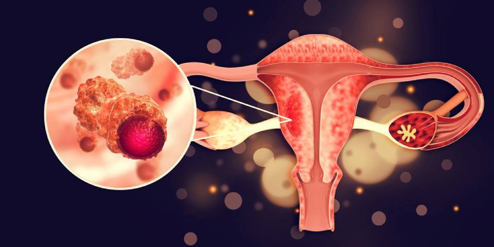 How Do I Know I Have Endometriosis?