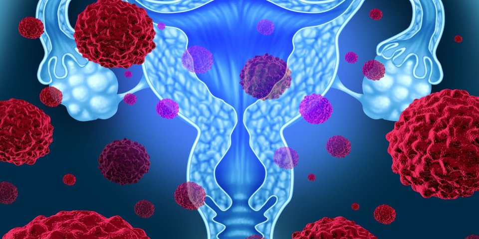 Uterine fibroids explained by Dr. Asmita Dongare - causes, symptoms, and treatments